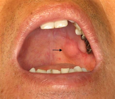 2 holes in roof of mouth|hard palate cancer photo.